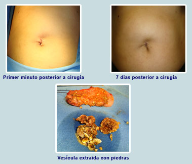 cirugia vesicula sin cicatriz