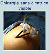 cirugia sin cicatriz visible